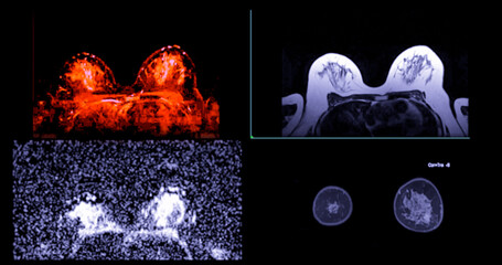 Color-enhanced breast MRI merges diagnostic power with visual impact, illuminating subtle lesions and tissue architecture.