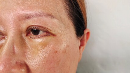 portrait the surgery plastic on the face, change and beauty concept, lifting and eyelid lift, Under eye fat removal and Reposition of the woman, Flabby skin and creases,health care and beauty concept