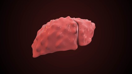 Severe Chronic Hepatitis B Medical Animation