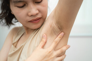 Asian woman have problem black armpit beauty skin care.