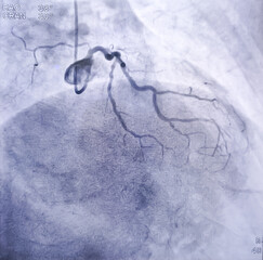 Coronary angiogram of left coronary artery during cardiac catheterization with contrast dye. Abnormal findings. Colour adjust.