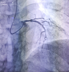 Coronary angiogram of left coronary artery during cardiac catheterization with contrast dye. Abnormal findings. Colour adjust.