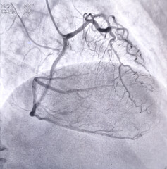 Coronary angiogram of left coronary artery during cardiac catheterization with contrast dye. Abnormal findings. Colour adjust.