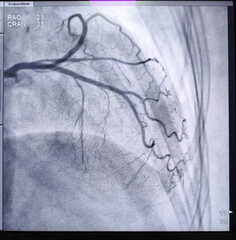 Coronary angiogram of left coronary artery during cardiac catheterization with contrast dye. Abnormal findings. Colour adjust.