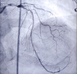 Coronary angiogram of left coronary artery during cardiac catheterization with contrast dye. Abnormal findings. Colour adjust.