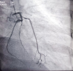 Coronary angiogram of left coronary artery during cardiac catheterization with contrast dye. Abnormal findings. Colour adjust.