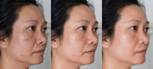 Image before and after spot melasma pigmentation treatment on skin face asian woman compare in 3 development periods. Skincare and beauty concept