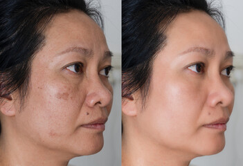 Cropped Image before and after spot melasma pigmentation facial treatment on middle age asian woman face. skincare and health problem concept.	