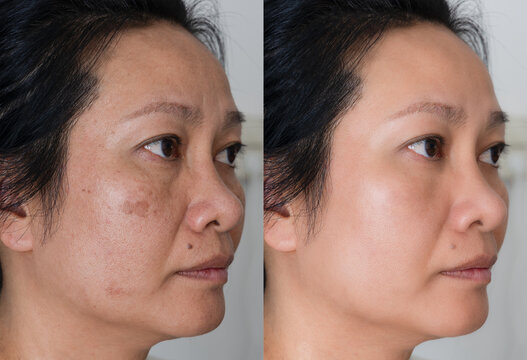 Cropped Image before and after spot melasma pigmentation facial treatment on middle age asian woman face. skincare and health problem concept.	