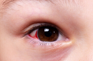 Bloodshot sick eyes close up