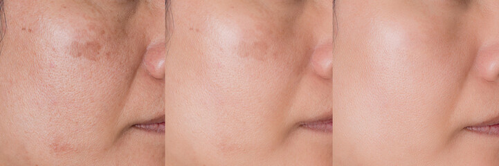 cropped Image before and after spot melasma pigmentation treatment on skin face asian woman compare in 3 development periods. Skincare and beauty concept
