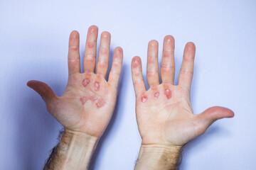 Man's hand with callus wound.