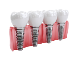 Dental implants, 4 teeth supported by metal implants.  Healthy, realistic 3D render