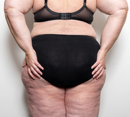Frau zeigt ihre Cellulite, Thema Abnehmen und Diät