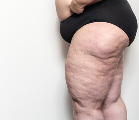 Frau zeigt ihre Cellulite, Thema Abnehmen und Diät