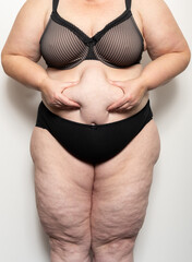 Frau zeigt ihre Cellulite, Thema Abnehmen und Diät