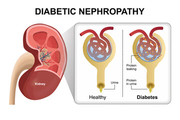 Diabetic Nephropathy (Kidney Disease)