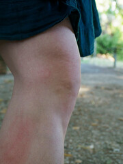 Inflamed red hives spreading across woman's skin after insect bite, causing severe itching and...