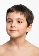 Portrait of a smiling young boy with mild acne on face