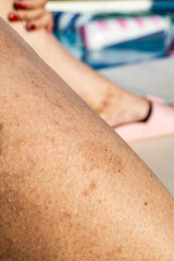 Café-au-Lait Spots on Skin of Patient with Neurofibromatosis Type 1 (NF1)