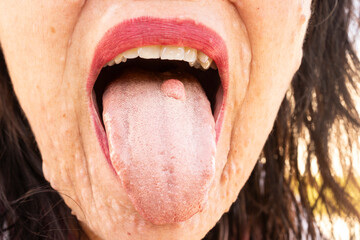 Tongue of Female Patient with Neurofibromatosis