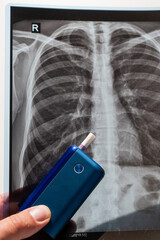 Electronic cigarette and lung x-ray. Tobacco heating system. 