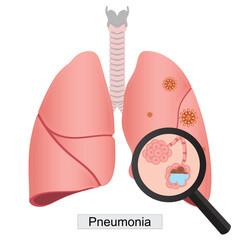 Pneumonia is an inflammatory condition of the lung.