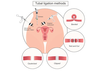 Tubal ligation is surgical procedure to prevent pregnancy.