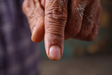 close up of old mans thumb very injured