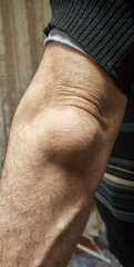 Close-up of a swollen elbow in an adult male, possibly showing signs of bursitis or inflammation. The skin is stretched, and the swelling is clearly visible on the joint.