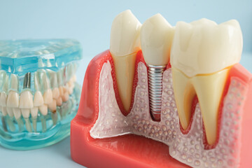 Dental implant, artificial tooth roots into jaw, root canal of dental treatment, gum disease, teeth model for dentist studying about dentistry.