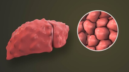 Hepatitis B Infection Damaging Liver Tissue Structure
