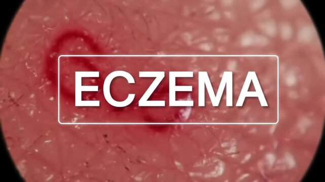 Eczema Rash Under Microscope with Medical Overlay &ndash; Inflamed Skin Surface and Red Patch Spreading Animation


