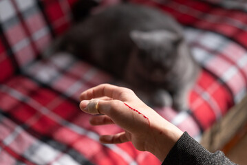 Cat scratched a child's hand while playing, wound visible. A scratch from a cat's claws is visible on a child's hand after playing