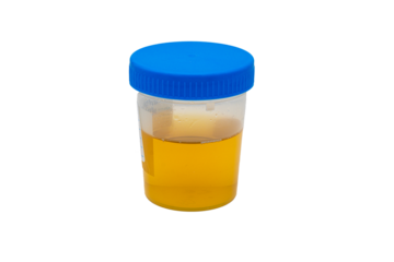 Urine sample