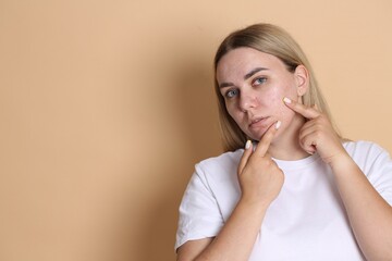 Woman with acne problem on beige background, space for text