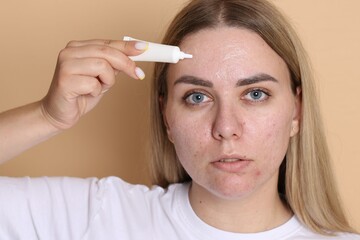 Woman applying cream onto face on beige background. Acne treatment