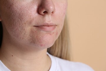 Fototapeta premium Woman with acne problem on beige background, closeup. Space for text