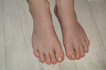 child's feet with uncut and dirty nails