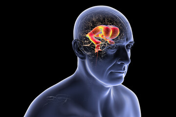 Normal pressure hydrocephalus, 3D illustration