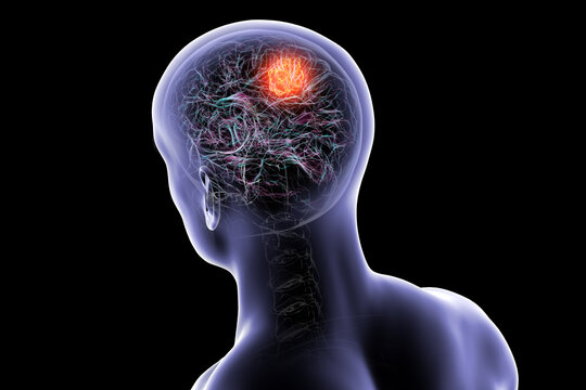 Brain tumor, 3D illustration