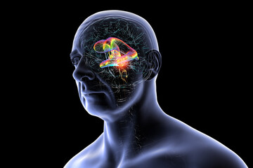 A brain tumor causing hydrocephalus, 3D illustration