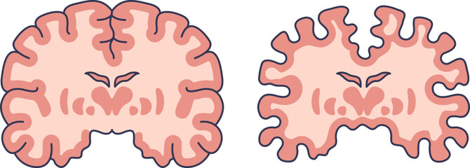 Illustration comparing a healthy brain cross-section to one with significant brain volume loss, showing cerebral atrophy and the effects of neurodegeneration.