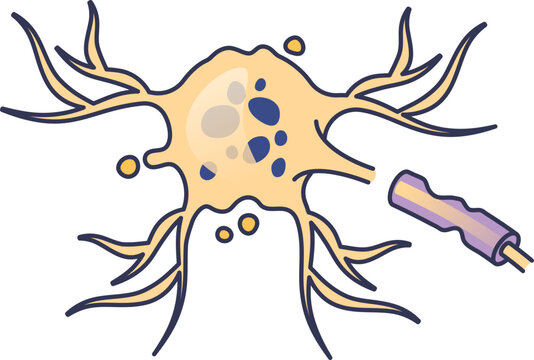 Illustration of an apoptotic neuron undergoing programmed cell death. Shows a fragmented nucleus, degenerating axon, and cellular blebbing, representing neurodegeneration.