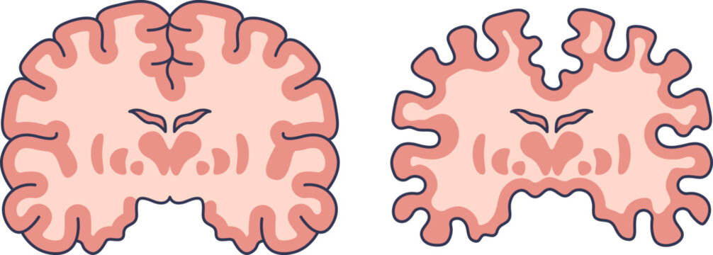 Illustration comparing a healthy brain cross-section to one with significant brain volume loss, showing cerebral atrophy and the effects of neurodegeneration.