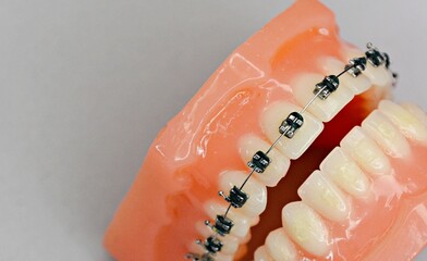 White background dentures with braces attached - for dental clinics
