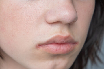 Obraz premium Close-up of ulcers on the lips with signs of pain and itching in the corners