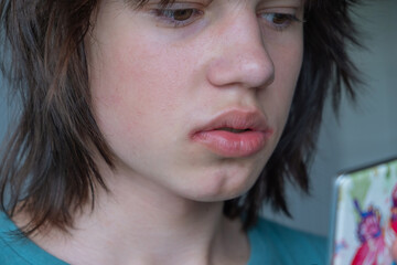 Pain and itching in the corners of the lips causing discomfort and distress