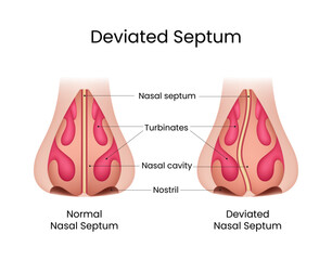 Normal Nasal Septum vs Deviated Nasal Septum