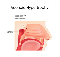 Adenoid Hypertrophy Anatomy and Obstruction